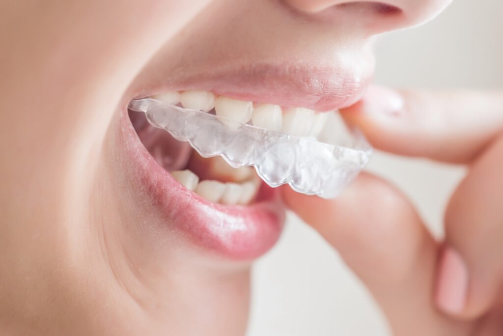 Smiling woman with invisalign, close up.