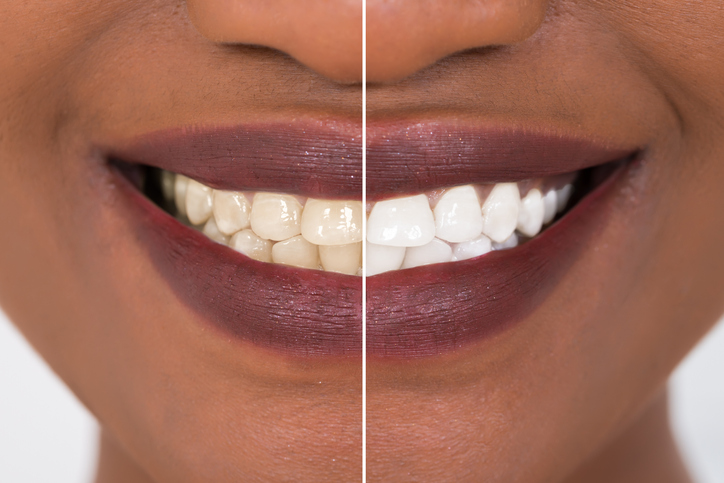 Close up of the smile of a woman with half of teeth whitened and half of teeth not