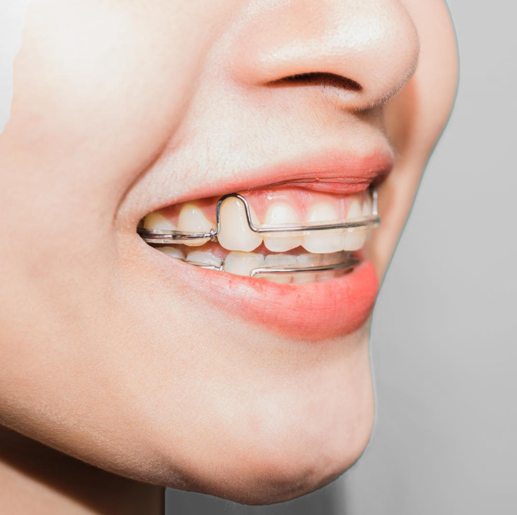 Close up if the mouth of a teenager smiling with a removable metal retainer in CT.