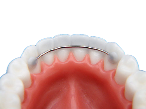 Dental model of a bonded, permanent retainer bonded to the back of the bottom row of teeth