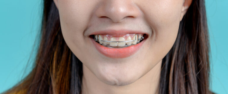 Close up of a smiling young woman with a metal removable retainer in New Haven, CT