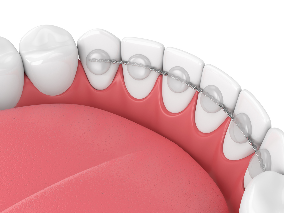 3-D model of part of a bonded retainer on the back of the bottom row of front teeth